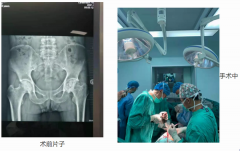 临沧市中医医院外一科独立成功完成人工陶瓷全髋关节置换手术